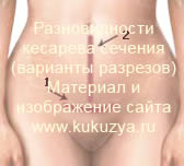 Разрез брюшной стенки: 1 - поперечный, 2 - продольный