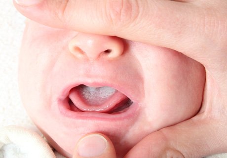 Молочница во рту у новорожденного (стоматит)