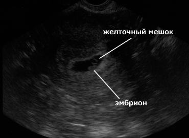 Плодное Яйцо 4 Недели Фото