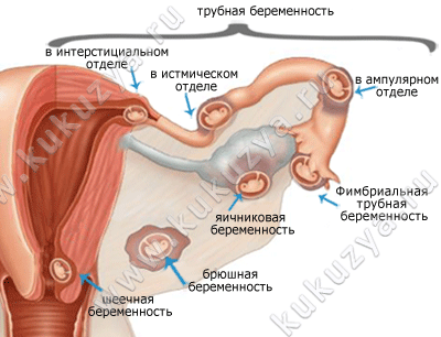 Внематочная беременность