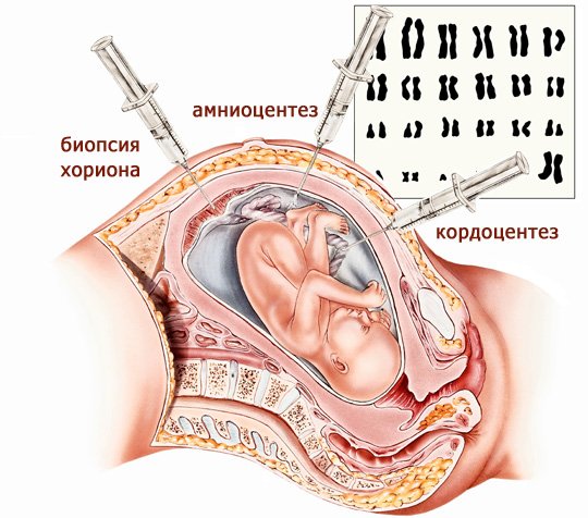 Инвазивные методы пренатальной диагностики