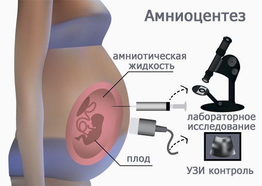 Амниоцентез. Проведение