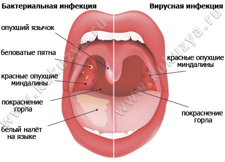 Виды Ангины Фото