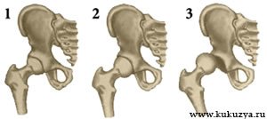 1 - Предвывих, 2 - Подвывих, 3 - Вывих