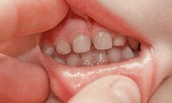 Самые ранние признаки кариеса молочных зубов у ребенка – эмаль имеет белые пятна вследствие деминерализации