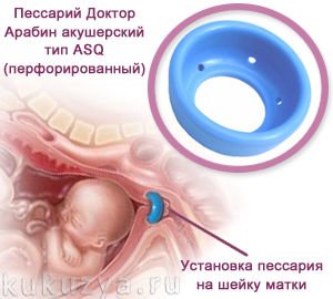 Акушерский пессарий: что это такое, зачем и как ставят при беременности кольцо на шейку матки?