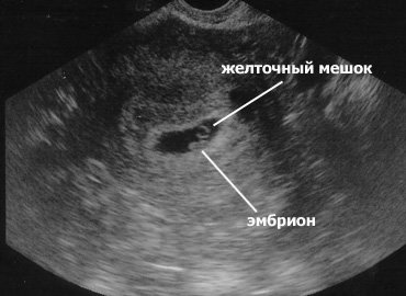 Плодное яйцо на УЗИ: виден желточный мешок и эмбрион.