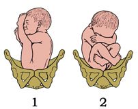 1 - ягодичное (неполное) предлежание; 2-смешанное ягодичное (полное) предлежание