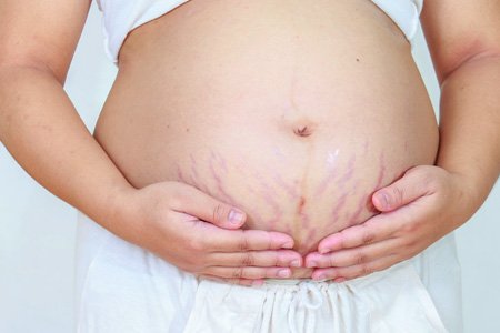 Растяжки (стрии) на коже при беременности