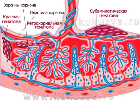 Ретрохориальная гематома при беременности