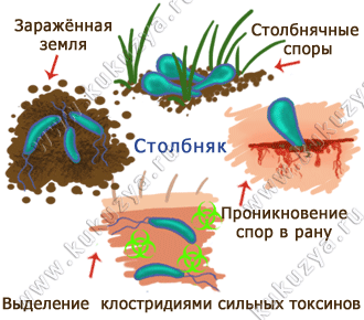 Заражение столбняком