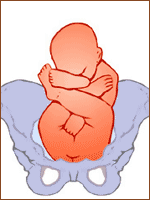 Продольное положение ягодичное (тазовое) предлежание