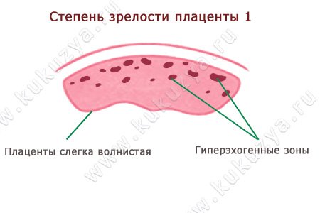 Степень зрелости плаценты – 1