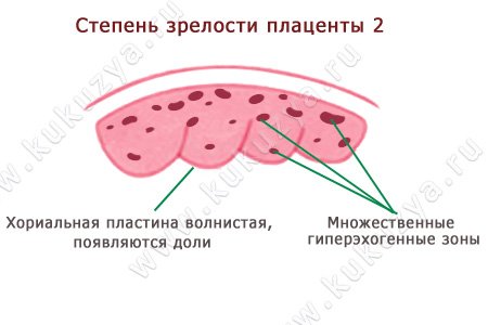 Степень зрелости плаценты – 2