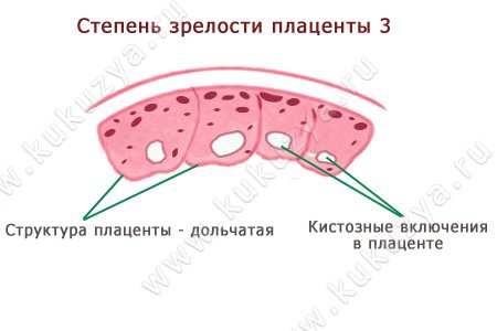 Степень зрелости плаценты – 3