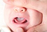Молочница во рту у новорожденного (стоматит)